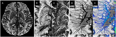 An Overview of Venous Abnormalities Related to the Development of Lesions in Multiple Sclerosis